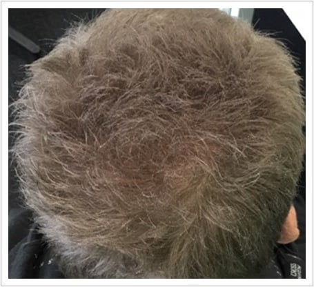 General Thinning hair transplant after, patient 3