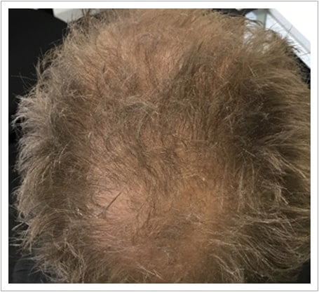 General Thinning hair transplant before, patient 3