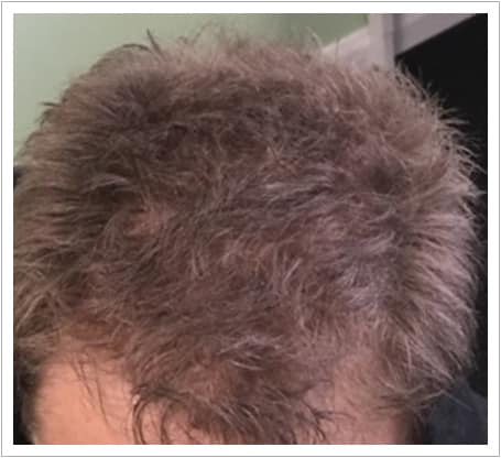 General Thinning hair transplant after, patient 4