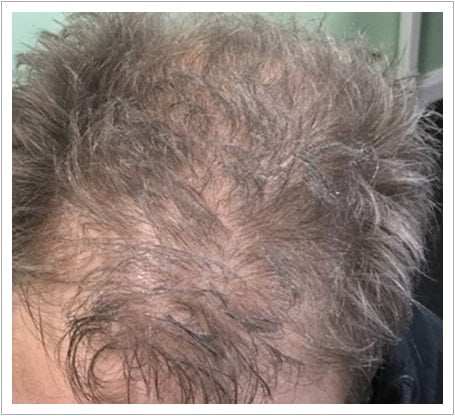 General Thinning hair transplant before, patient 4