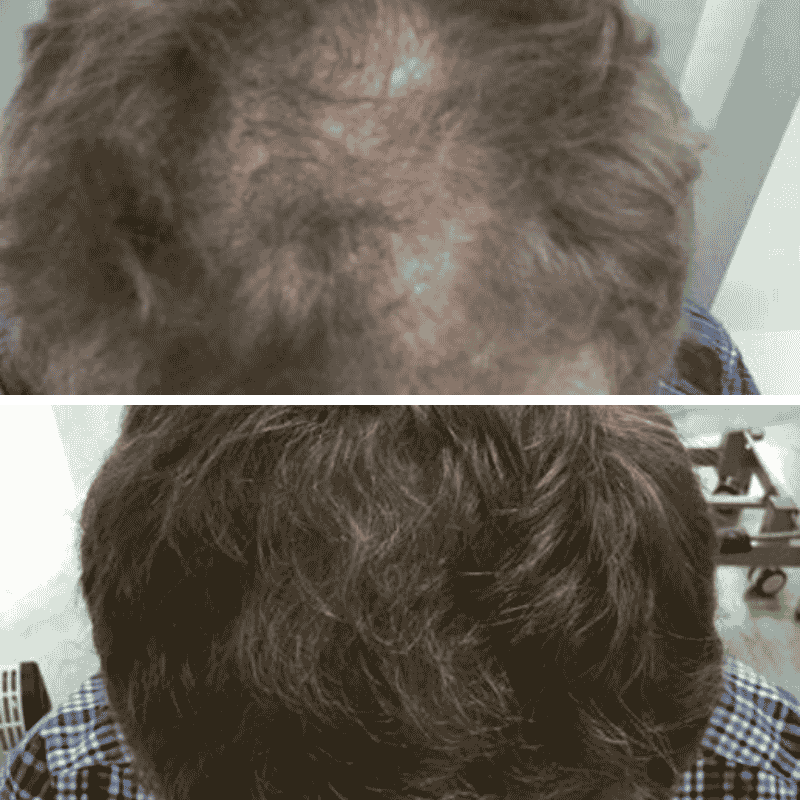 Non-surgical hair loss treatment before and after, thicker crown coverage