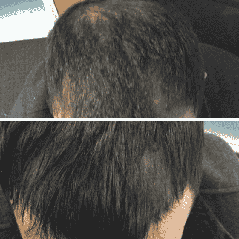 Non-surgical hair loss treatment before and after, reduced thinning