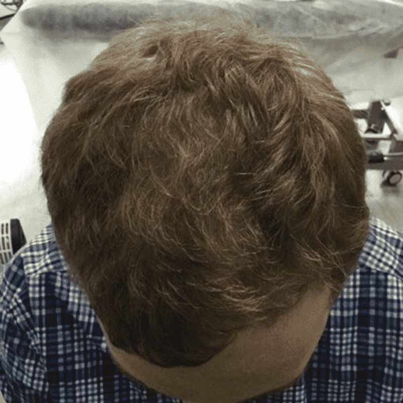Hair thickened with non-surgical hair loss treatment