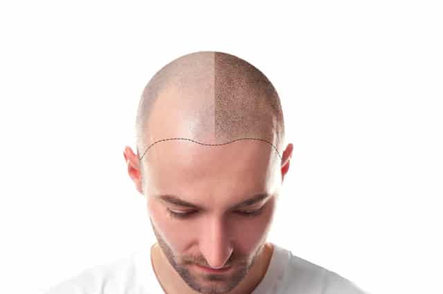 Scalp micro pigmentation hairline design, treated and untreated scalp compared