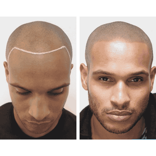 scalp micro pigmentation