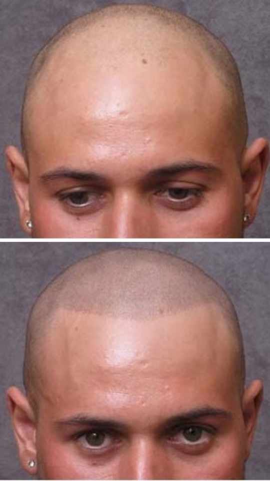 Scalp micro pigmentation before and after, hairline restored at UK Hair Transplant Clinics