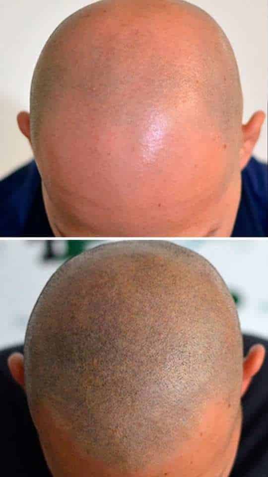 Scalp micro pigmentation before and after result at UK Hair Transplant Clinics