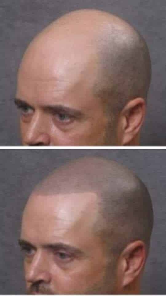 Scalp micro pigmentation before and after, density added at UK Hair Transplant Clinics